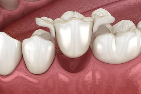 Most na prirodnim zubima