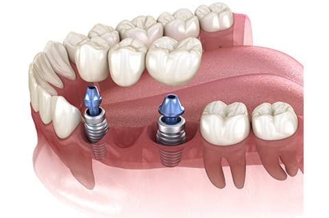 Most na implantatima