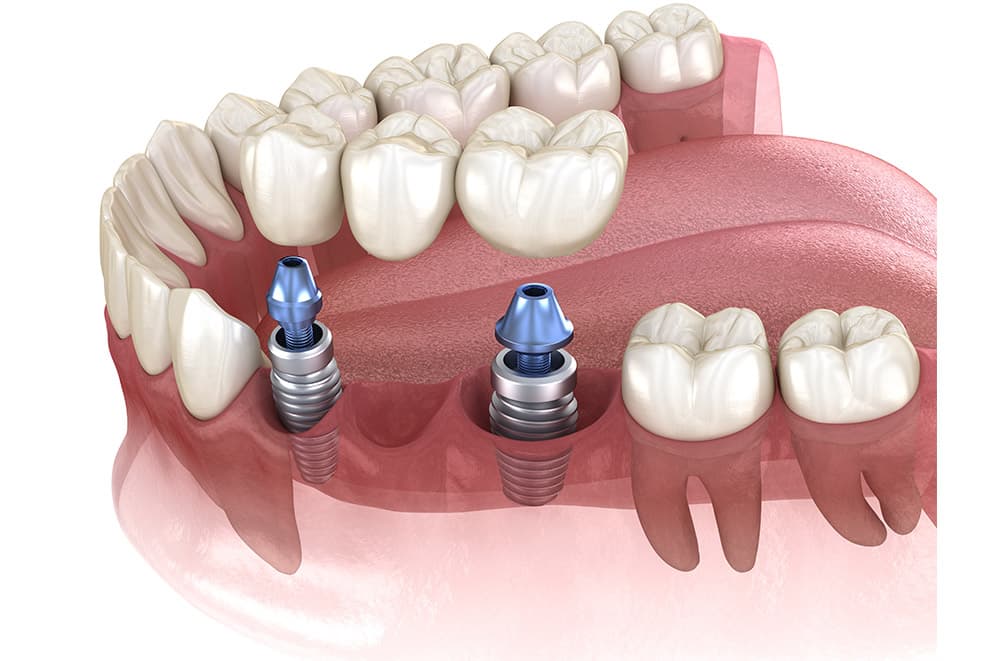 Most na implantatima