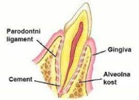 Gingivitis